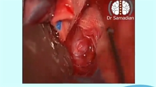 عمل جراحی آنوریسم شریان مغزی