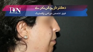 نمونه لیپوماتیک غبغب