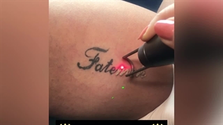 پاک کردن تتو ( کلینیک زیبایی استار بیوتی )