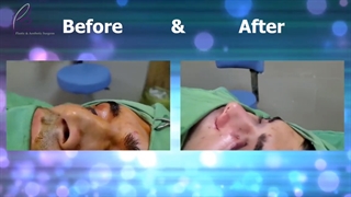 جراحی زیبایی بینی در آقای جوان