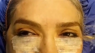فیلم جراحی پف پلک پایین