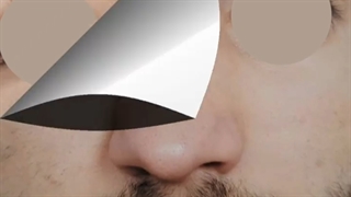 جراحی بینی در آقای جوان