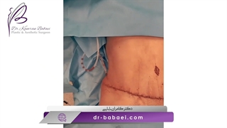 فیلم عمل ابدومینوپلاستی