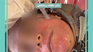 فیلم میکرونیدلینگ صورت