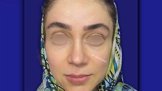 یکسال پس از لیفت آندوسکوپی ابروها ، پیشانی و تزریق چربی دور پلک ها