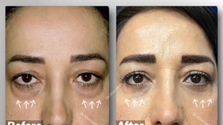 سه ماه بعد از بلفاروپلاستی ترانس کونژ ( از داخل پلک ) | دکتر خوروش