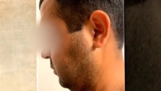 تغییرات قبل و بعد از هایفوتراپی صورت