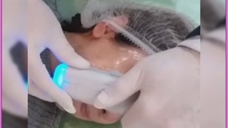 هایفوتراپی معجزه جوانسازی و لیفت صورت/هزینه و مزایا کلینیک لیزر