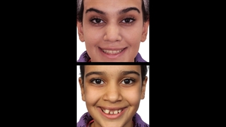 دندان اضافه و ارتودنسی | دکتر داودیان