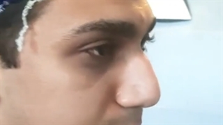 جراحی زیبایی بینی