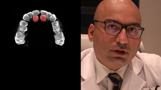 ارتودنسی ثنایای نهفته | دکتر داودیان