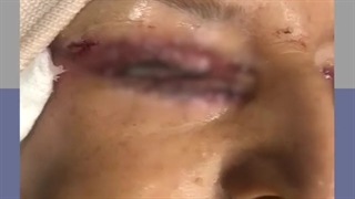 جراحی همزمان بلفاروپلاستی پلک فوقانی و تحتانی و لیفت ابرو و صورت