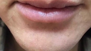 نمونه تزریق فیلر به لب