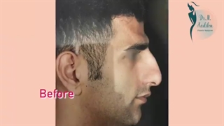 فیلم بدون سانسور اتاق عمل از عمل بینی مردانه