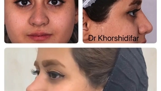 6 ماه بعد از جراحی زیبایی بینی