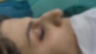 اصلاح انحراف بینی بسیار کج
