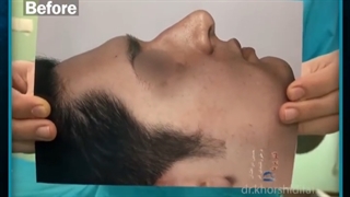 نتیجه جراحی بینی طبیعی مردانه بلافاصله بعد عمل