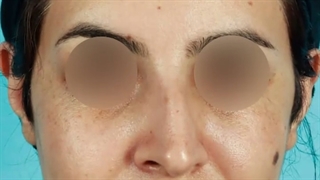 تنها سه هفته پس از جراحی بینی
