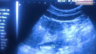 نتیجه IVF موفق