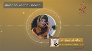 ماندگاری تزریق ژل ناحیه تناسلی بلیچینگ دندان