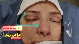جراحی بلفاروپلاستی و زیبایی بینی گوشتی به صورت همزمان