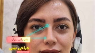 نتیجه بعد از یک سال جراحی بینی در مشهد