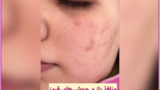 راهکارهای خانگی و دارویی درمان چربی پوست پروتز سینه
