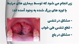جراحی لوزه | دکتر یحیوی