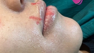 نمونه ای از تزریق ژل لب روسی