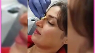 آشنایی با انواع روش های لیفت بینی بدون جراحی/ ژل و نخ