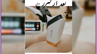 همه چیز در مورد لیزر بیکینی – هزینه و عوارض