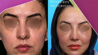 قبل و 23 روز بعد از تزریق چربی به صورت | دکتر یحیوی