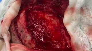 سینوزیت باکتریال که با گسترش بیماری دچار عفونت دورا(پرده ی مغز)شده