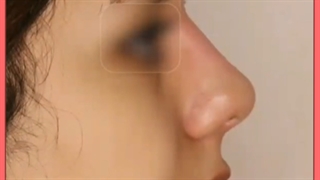 آشنایی با انواع روش های لیفت بینی بدون جراحی /ژل و نخ