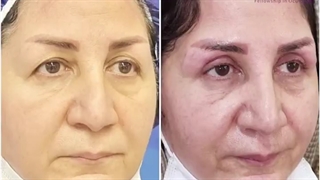 بلفاروپلاستی