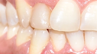 استریپ دندان.متخصص ارتودنسی تهران دکترعلیرضا خدیوی