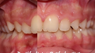 متخصص ارتودنسی دکترعلیرضاخدیویSUSارتودنسی ثابت همراه با دستگاه