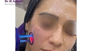 ترمیم و جوانسازی صورت با لیزر فرکشنال
