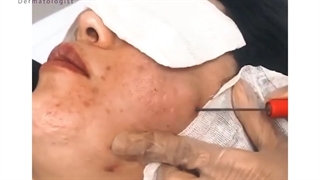 فیلم سابسیژن صورت به همراه اندو اراف