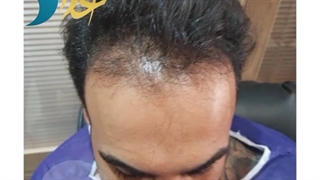 نمونه قبل و بعد از کاشت مو مراجعه کننده عزیزمون