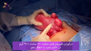 جراحی فوق سنگین فیبروم در خانم جوان مجرد ۳۲ ساله