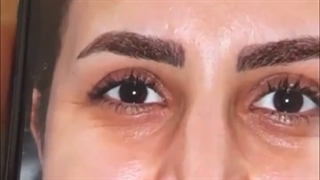 جراحی زیبایی بینی