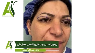 جراحی زیبایی بینی همراه با بلفاروپلاستی