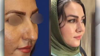 عمل زیبایی بینی | دکتر گلی