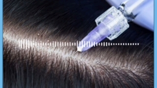 هزینه و مزایای استفاده از فیلر مو