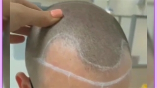 هزینه مزایا و مراحل کاشت مو به روش میکروگرافت