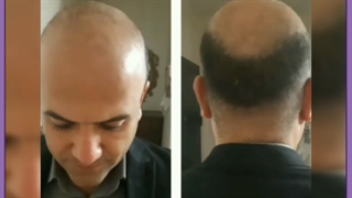 کاشت مو به روش SUT | هزینه، مزایا، مراحل و عوارض احتمالی