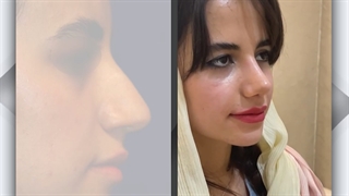 رضایت بیمار عزیزسه هفته بعد از عمل بینی | دکتر گلی