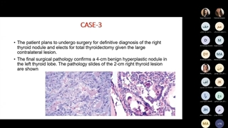Diagnosis And Management Of Thyroid Nodules - قسمت 5