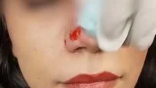 فیلم کوچک کردن بینی با آنزیم
